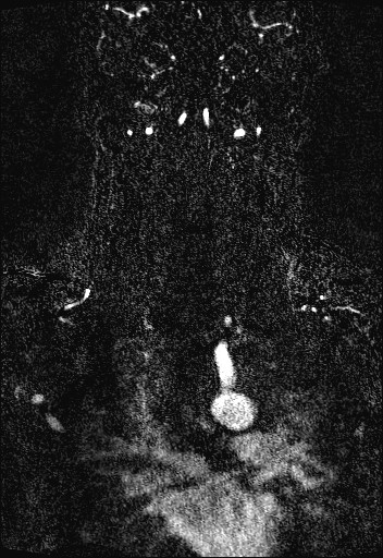 Carotid artery dissection (Radiopaedia 28441-28689 Coronal MRA 67).jpg