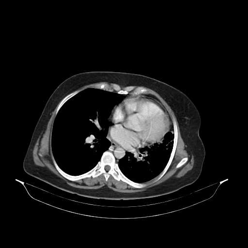 File:Carotid body tumor (Radiopaedia 21021-20948 B 44).jpg