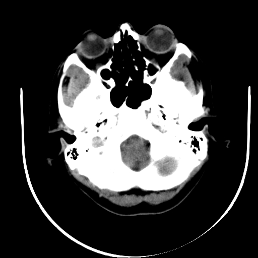 File:Carotid body tumor (Radiopaedia 27890-28124 A 2).jpg
