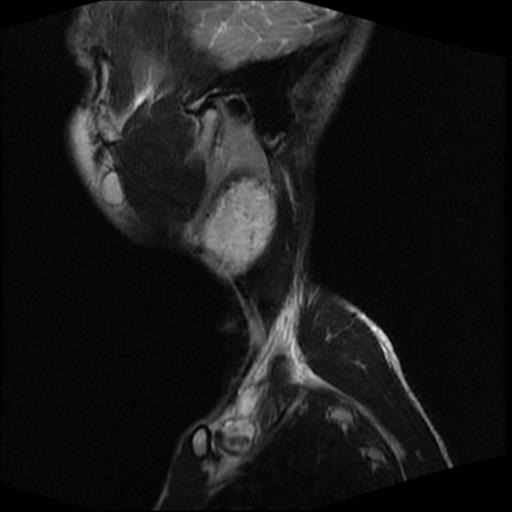 File:Carotid body tumor (Radiopaedia 30208-30823 Sagittal T2 18).jpg