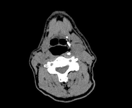 Carotid body tumor (Radiopaedia 61750-69757 Axial non-contrast 53).jpg
