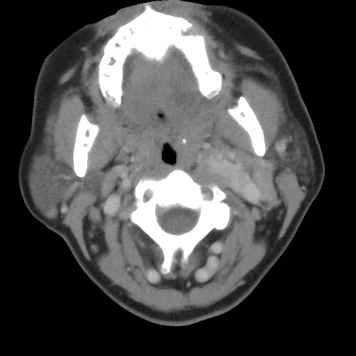 File:Carotid body tumor (paraganglioma) (Radiopaedia 38586-40729 A 12).jpg