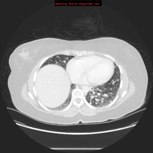 File:Carotid body tumor with lung metastases (Radiopaedia 9301-48390 Axial lung window 48).jpg