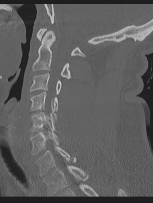 Cavernoma of cervical cord (Radiopaedia 50838-56346 Sagittal bone window 37).png