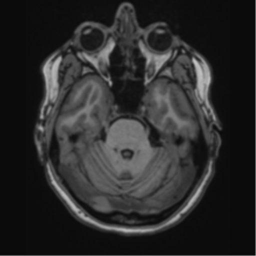 Cavernoma with bleed - midbrain (Radiopaedia 54546-60774 Axial T1 6).png