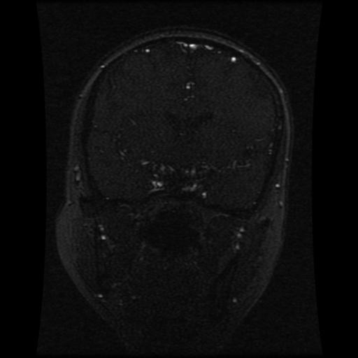 Cavernoma with developmental venous anomaly (Radiopaedia 22470-22507 MRV 83).jpg