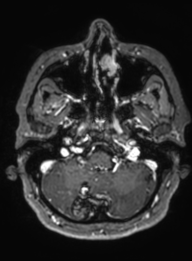 File:Cavernous hemangioma of the cerebellar falx (Radiopaedia 73025-83724 Axial T1 C+ 277).jpg
