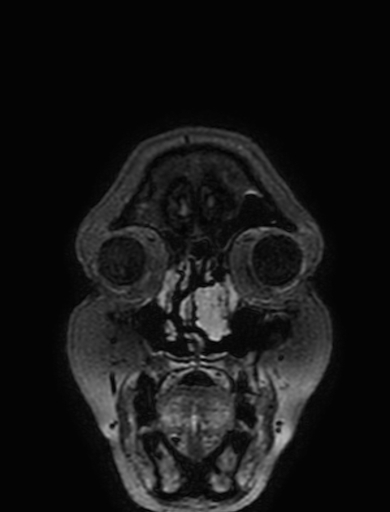 Cavernous hemangioma of the cerebellar falx (Radiopaedia 73025-83724 Coronal FLAIR 10).jpg