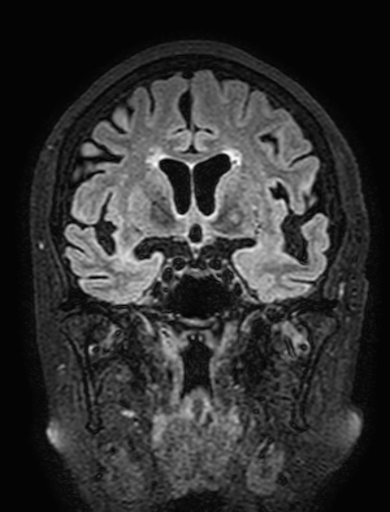 Cavernous hemangioma of the cerebellar falx (Radiopaedia 73025-83724 Coronal FLAIR 139).jpg