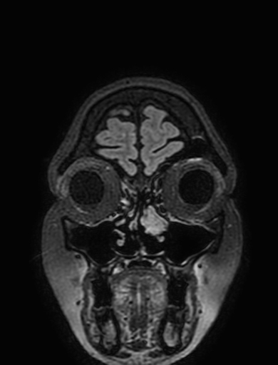 Cavernous hemangioma of the cerebellar falx (Radiopaedia 73025-83724 Coronal FLAIR 26).jpg