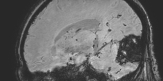 File:Cavernous hemangioma of the cerebellar falx (Radiopaedia 73025-83724 Sagittal BOLD 79).jpg