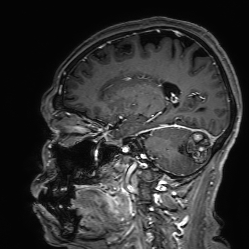 Cavernous hemangioma of the cerebellar falx (Radiopaedia 73025-83724 Sagittal T1 C+ 135).jpg