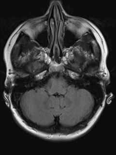 File:Cavernous malformation (cavernous angioma or cavernoma) (Radiopaedia 36675-38237 Axial T2 FLAIR 4).png