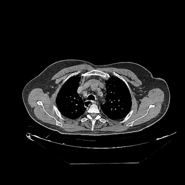 Cavitating bronchogenic carcinoma (Radiopaedia 44489-48162 Axial non-contrast 15).jpg