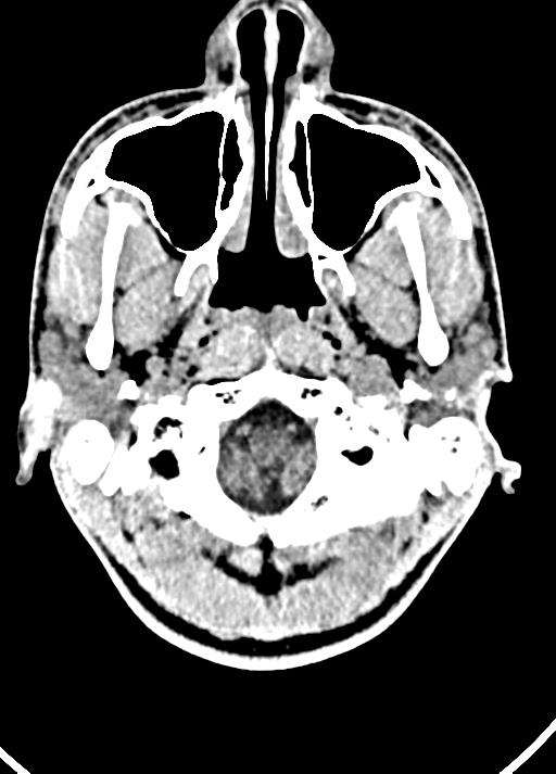 Cavum septum pellucidum and cavum vergae (Radiopaedia 77797-90060 Axial Brain Window 10).jpg