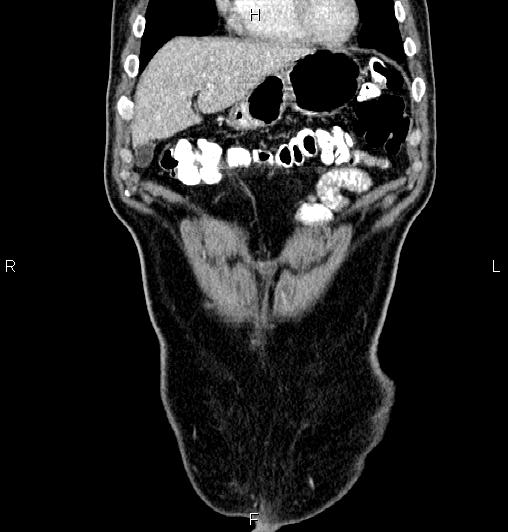 Cecal adenocarcinoma (Radiopaedia 85324-100916 D 11).jpg