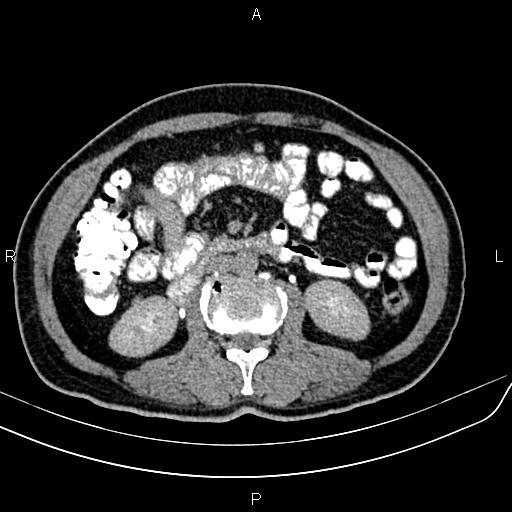 File:Cecal cancer with appendiceal mucocele (Radiopaedia 91080-108651 Axial C+ delayed 30).jpg