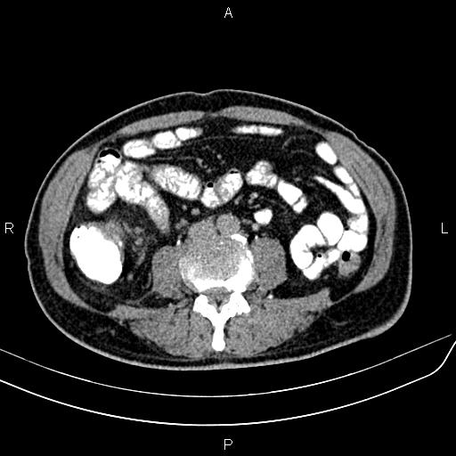 File:Cecal cancer with appendiceal mucocele (Radiopaedia 91080-108651 Axial C+ delayed 40).jpg