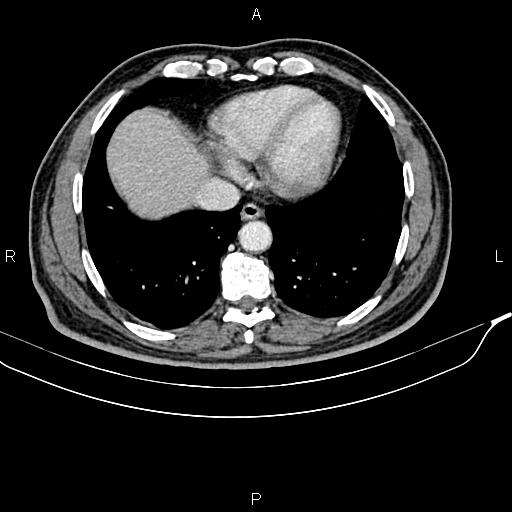 File:Cecal cancer with appendiceal mucocele (Radiopaedia 91080-108651 B 13).jpg