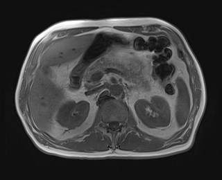 Cecal mass causing appendicitis (Radiopaedia 59207-66532 Axial T1 in-phase 49).jpg