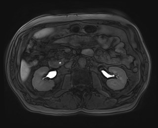 Cecal mass causing appendicitis (Radiopaedia 59207-66532 K 59).jpg