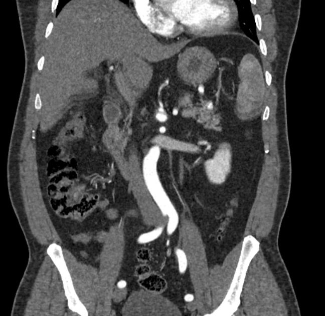 Celiac artery dissection (Radiopaedia 52194-58080 C 51).jpg