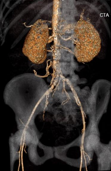 File:Celiac artery severe stenosis and dissection (Radiopaedia 44128-47842 C+ arterial phase 16).jpg