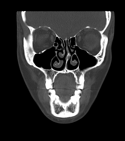 Cemento-ossifying fibroma (Radiopaedia 46243-50643 Coronal bone window 19).png