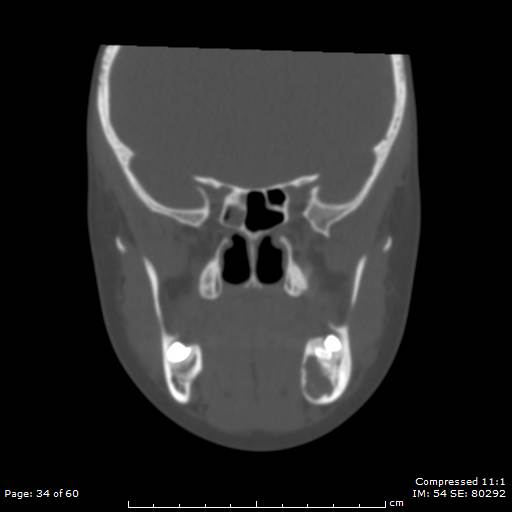 File:Central giant cell granuloma (Radiopaedia 45612-49754 Coronal bone window 34).jpg