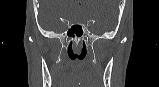 File:Central giant cell granuloma (Radiopaedia 83346-97761 Coronal bone window 22).jpg