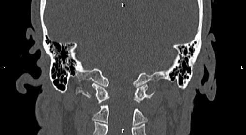 File:Central giant cell granuloma (Radiopaedia 83346-97761 Coronal bone window 37).jpg