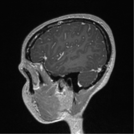 Central neurocytoma (Radiopaedia 37664-39557 Sagittal T1 C+ 20).png