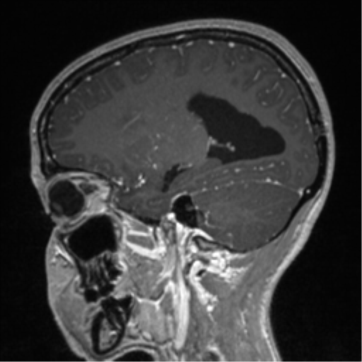 File:Central neurocytoma (Radiopaedia 37664-39557 Sagittal T1 C+ 33).png