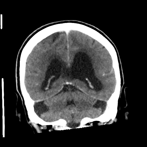 Central neurocytoma (Radiopaedia 65317-74346 Coronal C+ delayed 40).png
