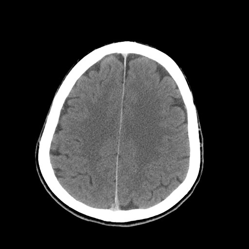 Central neurocytoma (Radiopaedia 68725-78432 Axial C+ 68).jpg