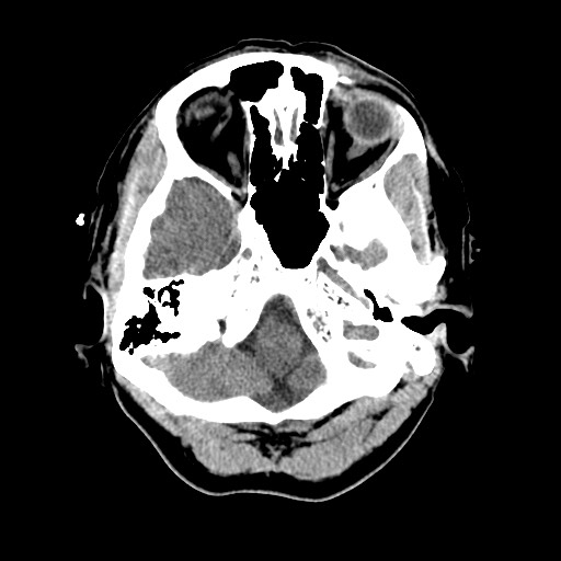 Central neurocytoma (Radiopaedia 68725-78432 Axial non-contrast 8).jpg