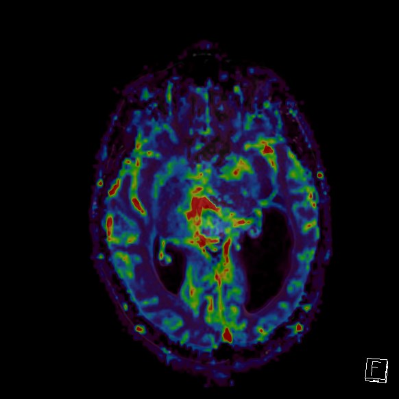 Central neurocytoma (Radiopaedia 84497-99872 Axial Perfusion 175).jpg