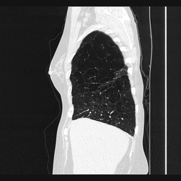 Centrilobular pulmonary emphysema (Radiopaedia 24495-24789 Sagittal lung window 13).jpg