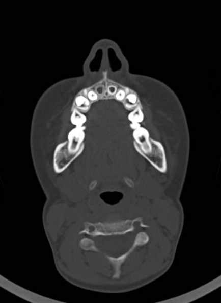 Cerebellar abscess (Radiopaedia 73727-84527 Axial bone window 5).jpg