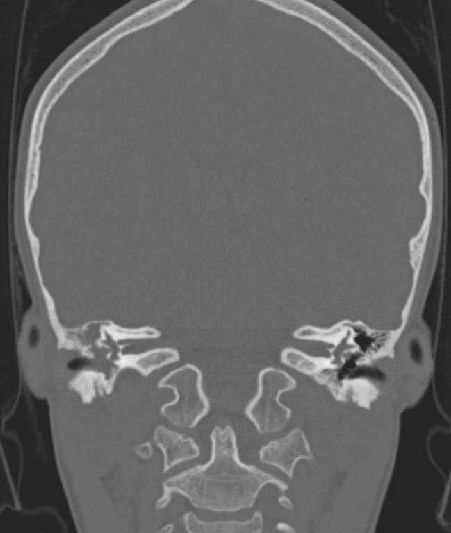 Cerebellar abscess (Radiopaedia 73727-84527 Coronal bone window 58).jpg