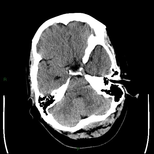 Cerebellar abscess (Radiopaedia 78135-90671 Axial non-contrast 30).jpg