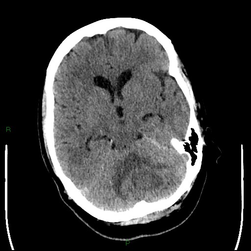 Cerebellar abscess (Radiopaedia 78135-90671 Axial non-contrast 43).jpg