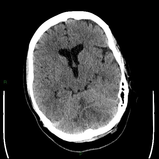Cerebellar abscess (Radiopaedia 78135-90671 Axial non-contrast 47).jpg