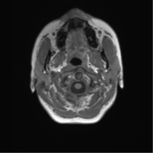Cerebellar agenesis with hypoplastic pons (pontocerebellar hypoplasia) (Radiopaedia 57224-64138 Axial T1 5).png