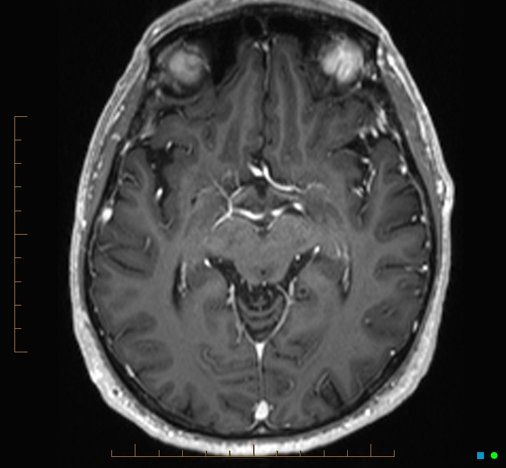 Cerebellar gangliocytoma (Radiopaedia 65377-74422 Axial T1 C+ 55).jpg