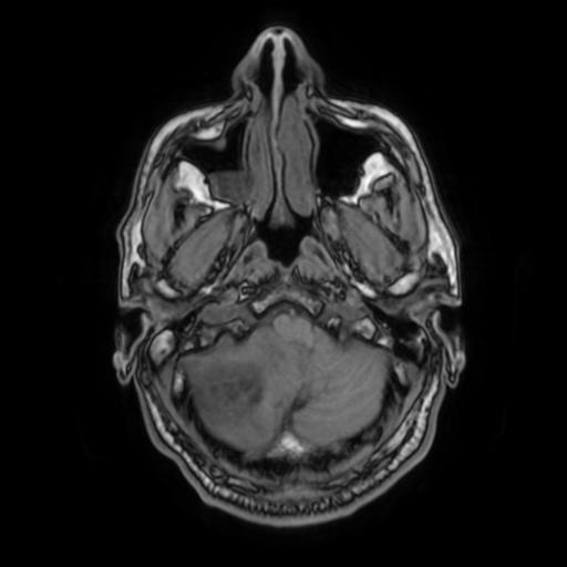 File:Cerebellar hemangioblastoma (Radiopaedia 88055-104622 Axial T1 8).jpg