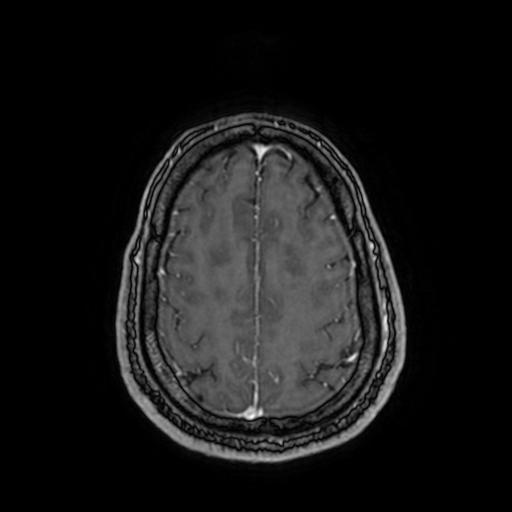 Cerebellar hemangioblastoma (Radiopaedia 88055-104622 Axial T1 C+ 139).jpg