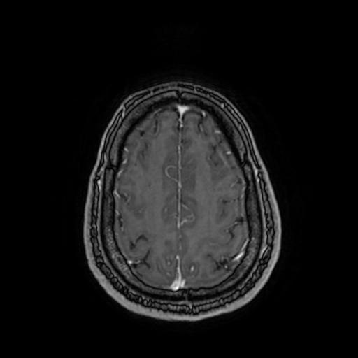 Cerebellar hemangioblastoma (Radiopaedia 88055-104622 Axial T1 C+ 142).jpg