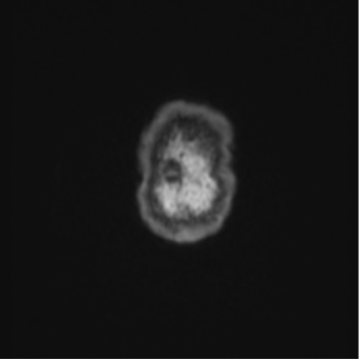 Cerebellar hemangioblastomas and pituitary adenoma (Radiopaedia 85490-101176 Coronal T1 3).png
