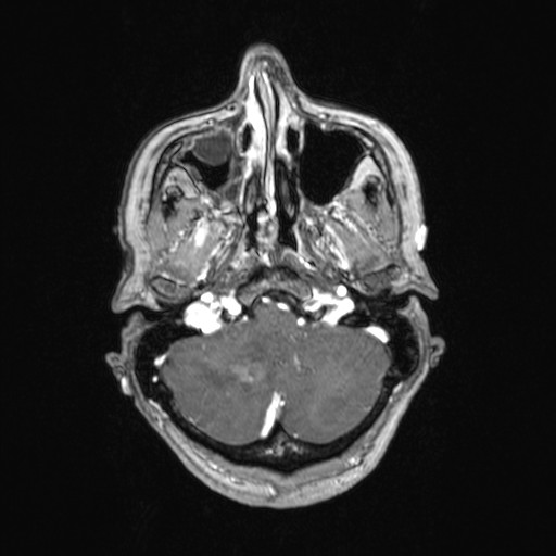 Cerebellar metastases (Radiopaedia 24038-24249 Axial T1 C+ 48).jpg